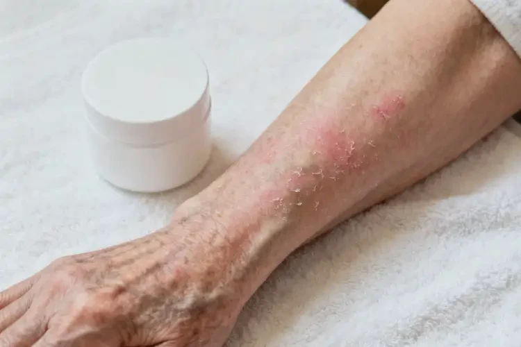 老人手臂偶爾起濕疹不管它會自己好嗎(圖4)