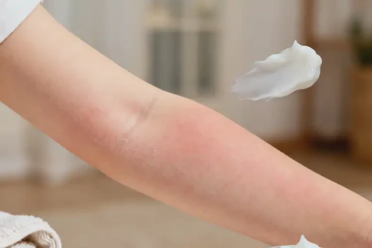 小孩手臂上出現(xiàn)濕疹能靠自己自愈嗎(圖4)