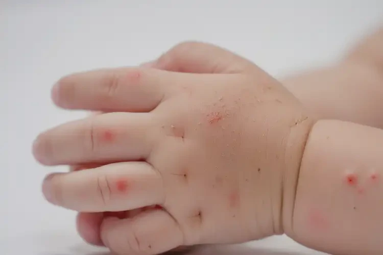 小孩手上長濕疹不管它會自己痊愈嗎(圖4)