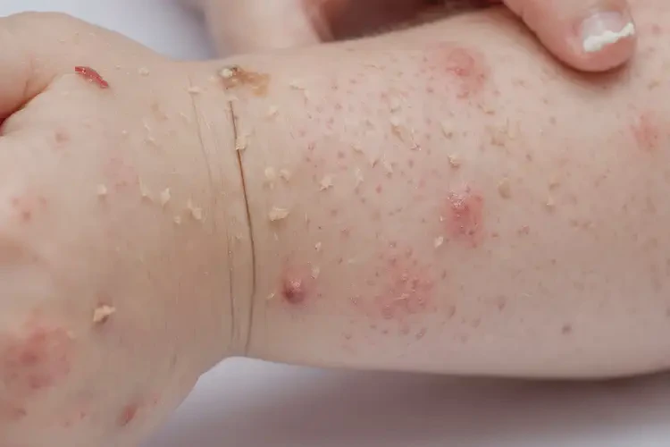 小孩身上容易長(zhǎng)濕疹能徹底自愈嗎(圖4)