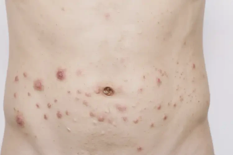 青年人肚子經(jīng)常起濕疹不管它會(huì)自己痊愈嗎(圖4)