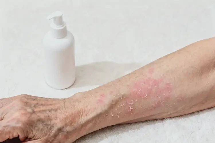 老人手臂偶爾起濕疹不管它會自己好嗎(圖2)