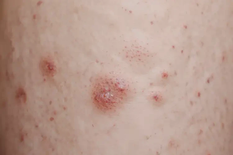 中學(xué)生大腿上偶爾起濕疹可以徹底自愈嗎(圖4)