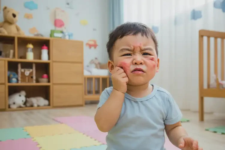 幼兒臉上經(jīng)常起濕疹能靠自己自愈嗎(圖3)