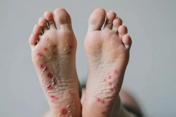 孕婦腳上起濕疹不管它會(huì)自己痊愈嗎(圖2)