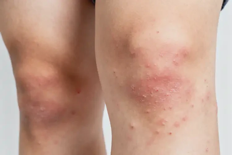 青年人大腿上出現(xiàn)濕疹不管它會自己好嗎(圖1)