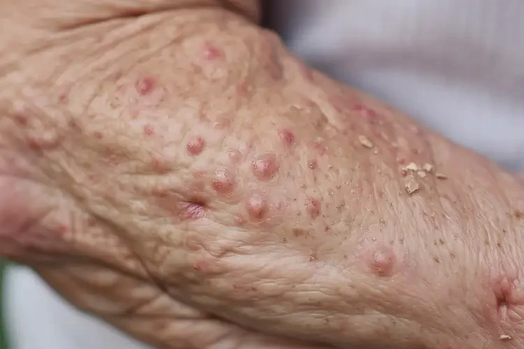 高齡老人身上容易起濕疹不管它會(huì)自己自愈嗎(圖4)