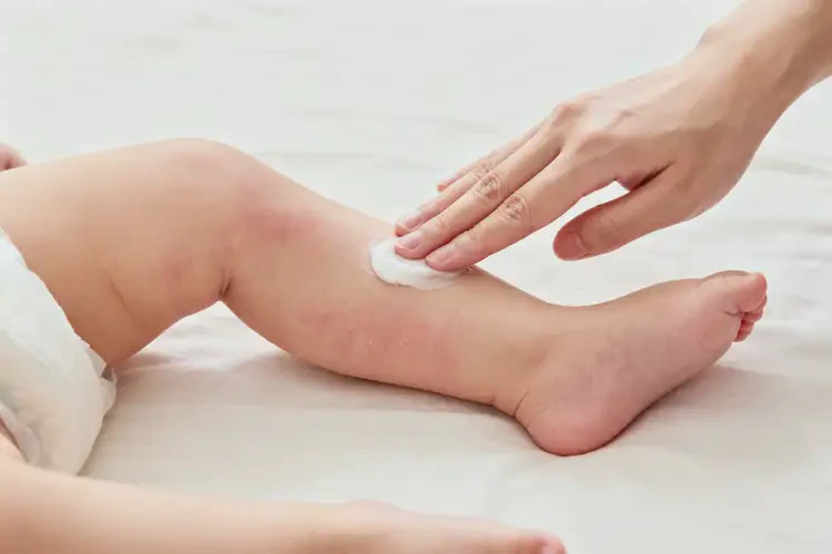嬰兒小腿有濕疹不管它會(huì)自己痊愈嗎(圖3)