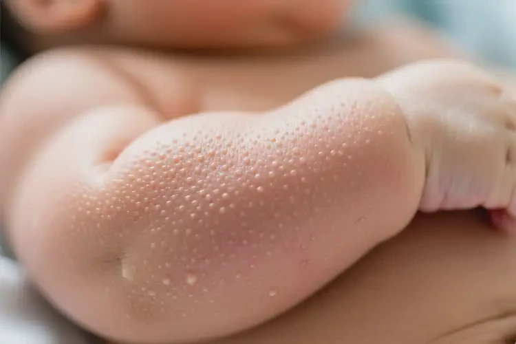 嬰兒手臂起濕疹可不可以徹底自愈(圖1)