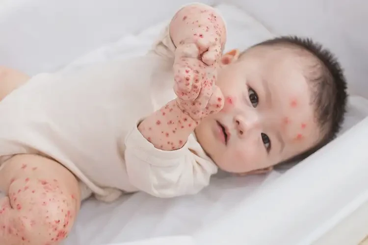 嬰幼兒四肢容易起濕疹不管它會自己痊愈嗎(圖4)