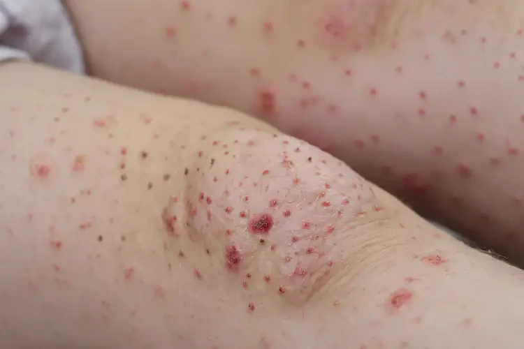 小兒小腿上經(jīng)常長濕疹能靠自己自愈嗎(圖4)