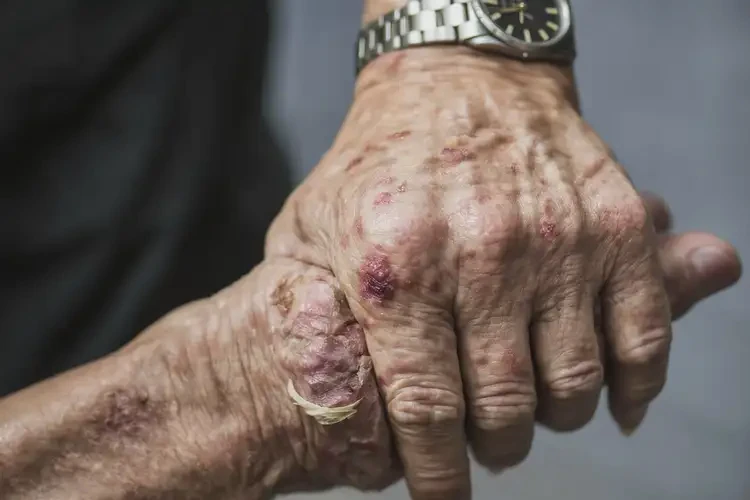 老年人手上偶爾起濕疹可不可以徹底自愈(圖4)