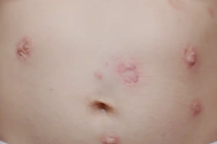 嬰兒肚子容易長濕疹可以徹底自愈嗎(圖4)