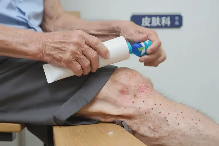 老年人小腿上偶爾起濕疹能靠自己自愈嗎(圖4)