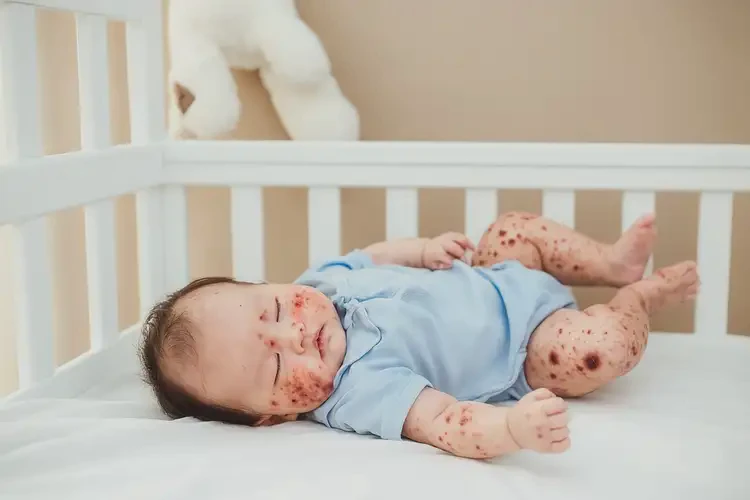 嬰幼兒四肢容易起濕疹不管它會自己痊愈嗎(圖3)