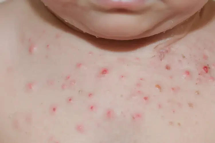 孩子脖子經(jīng)常長濕疹能夠徹底治愈嗎(圖4)