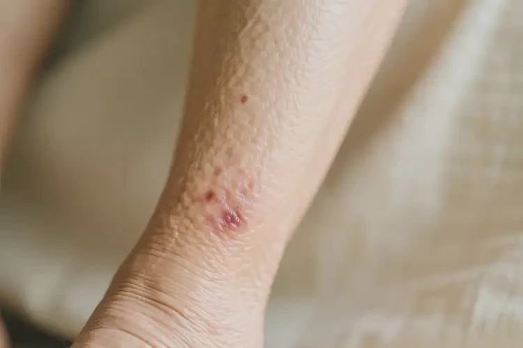 高齡老人小腿經(jīng)常起濕疹不管它會(huì)自己自愈嗎(圖2)