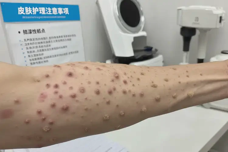 大學生全身偶爾長濕疹不管它會自己痊愈嗎(圖3)