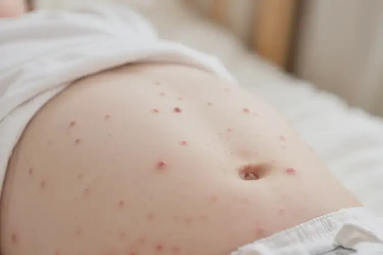 宝宝肚子上偶尔起湿疹不管它会自己好吗(图4)