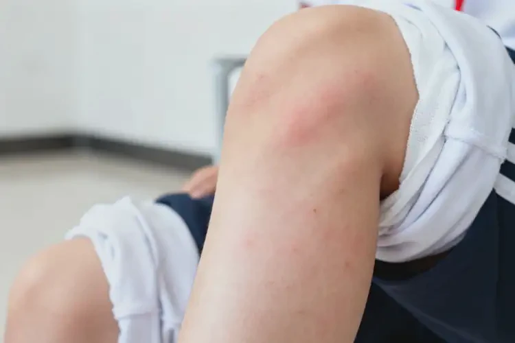 中學(xué)生小腿偶爾長濕疹可不可以徹底自愈(圖1)