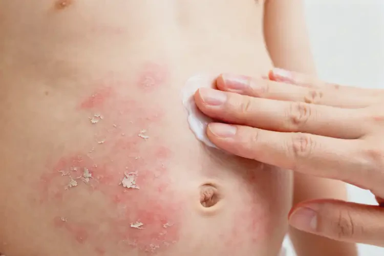 少兒肚子上出現(xiàn)濕疹不管它會自己自愈嗎(圖2)