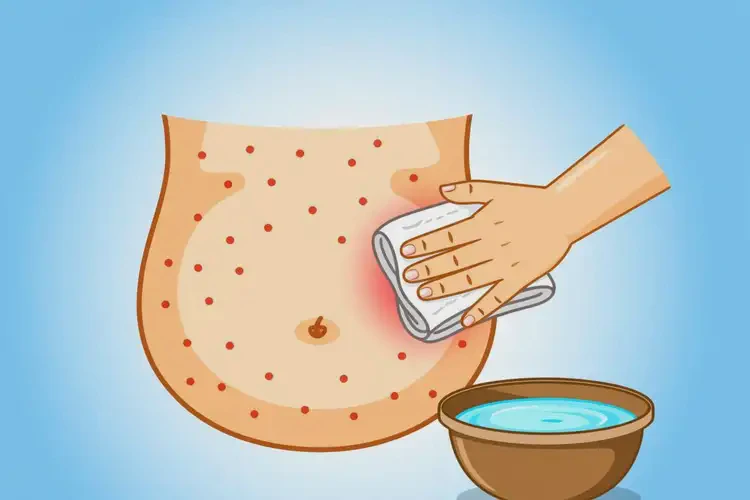 兒童肚子出濕疹能靠自己自愈嗎(圖4)