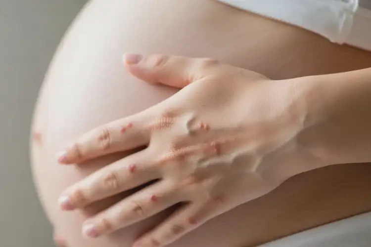 孕婦手上容易起濕疹不管它會自己自愈嗎(圖4)