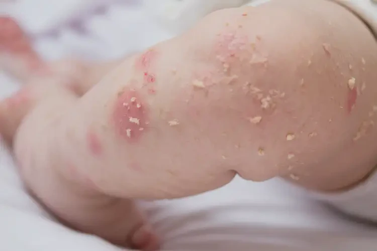 婴儿小腿上经常起湿疹不管它会自己好吗(图1)