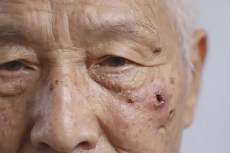 老年人面部經(jīng)常長(zhǎng)濕疹能不能徹底自愈(圖4)