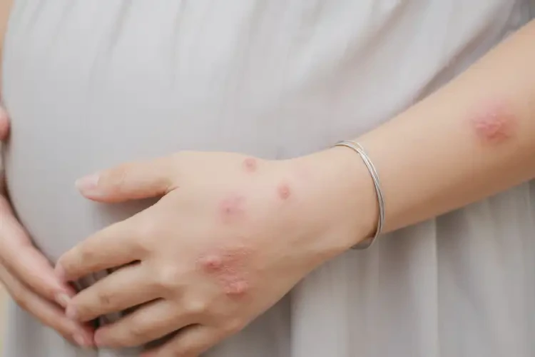 孕妇手臂上偶尔起湿疹不管它会自己好吗(图4)
