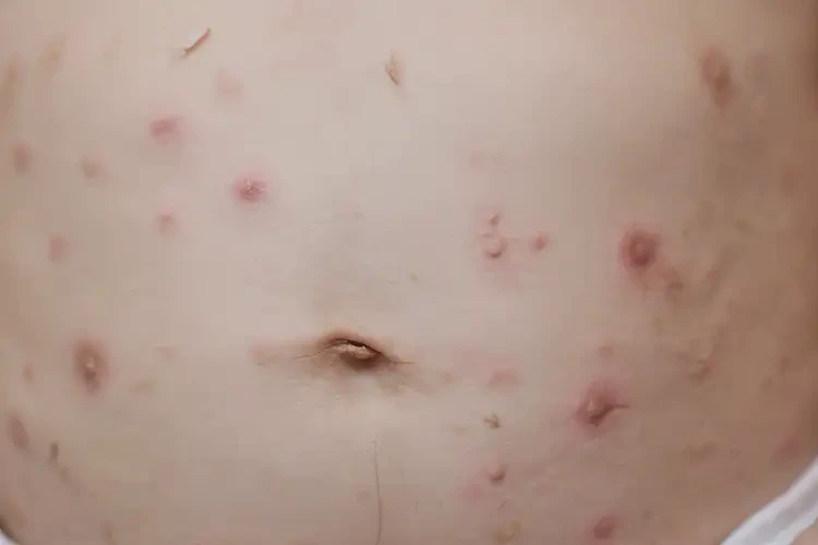 寶寶肚子上起濕疹可以徹底自愈嗎(圖4)