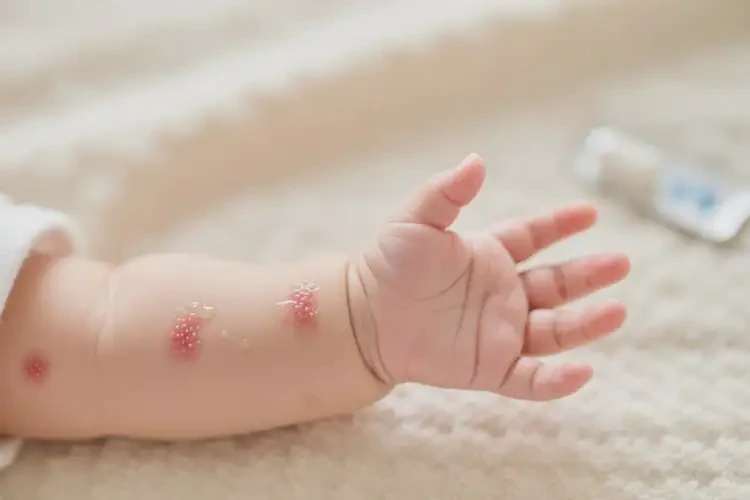 嬰兒手臂容易長(zhǎng)濕疹不管它會(huì)自己自愈嗎(圖1)