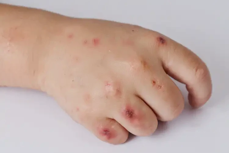 小學(xué)生手上容易長(zhǎng)濕疹不管它會(huì)自己好嗎(圖4)