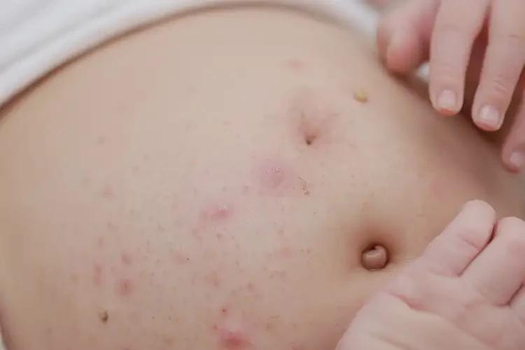 新生兒肚子上出濕疹可以徹底自愈嗎(圖4)