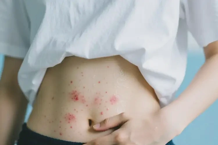 大學(xué)生肚子上出濕疹不管它會(huì)自己自愈嗎(圖3)