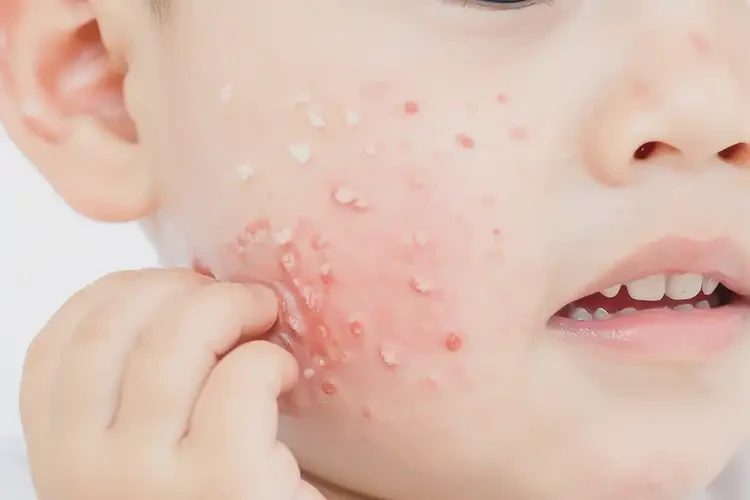 少兒面部長濕疹可不可以徹底自愈(圖4)