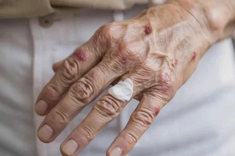 老年人手上容易長(zhǎng)濕疹不管它會(huì)自己自愈嗎(圖3)