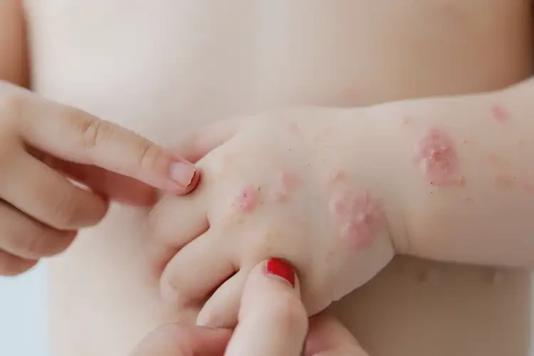 小兒手臂上經(jīng)常起濕疹不管它會(huì)自己好嗎(圖4)