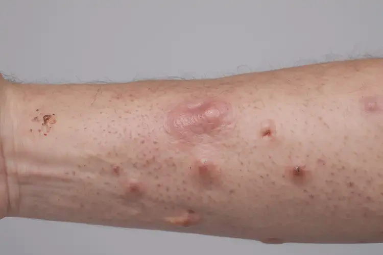 少兒脖子上偶爾起濕疹不管它會自己痊愈嗎(圖3)