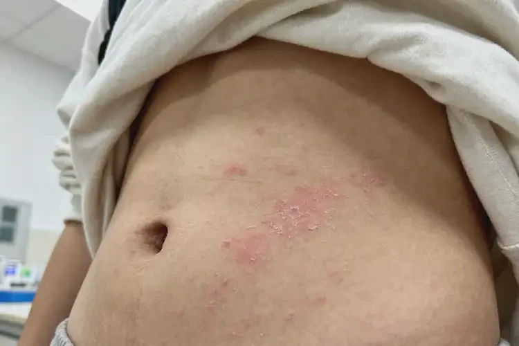 大學(xué)生肚子上起濕疹可以徹底自愈嗎(圖1)