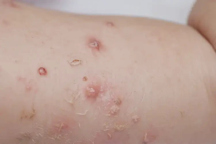嬰幼兒身上容易起濕疹能靠自己自愈嗎(圖4)