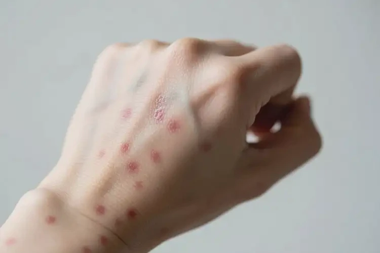 女性手上偶爾起濕疹能靠自己自愈嗎(圖2)