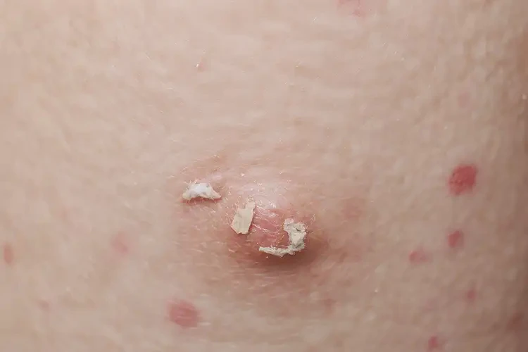 兒童身上經(jīng)常長濕疹不管它會自己痊愈嗎(圖4)