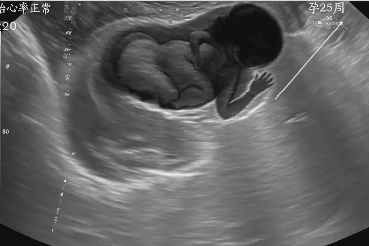 孕25周1天胎心率179有危險(xiǎn)嗎(圖4)