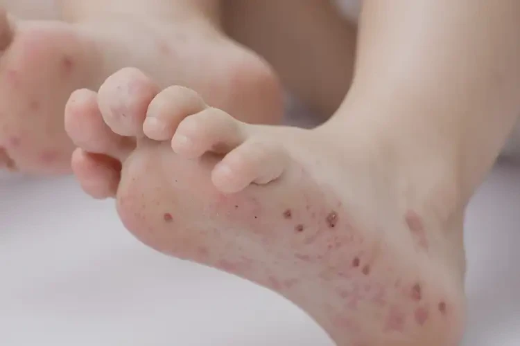 小孩腳上偶爾長濕疹不管它會自己自愈嗎(圖4)