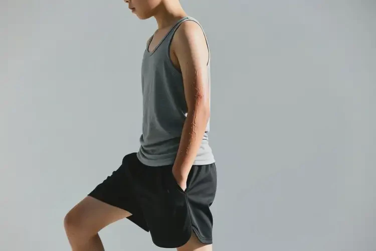 青少年全身經常起濕疹不管它會自己痊愈嗎(圖3)