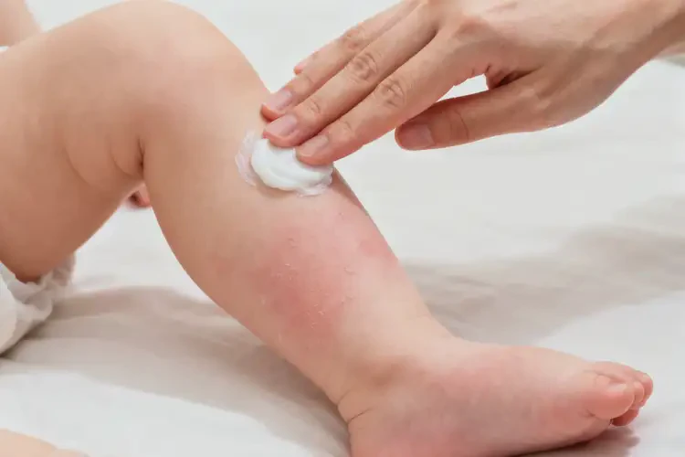 嬰兒小腿有濕疹不管它會(huì)自己痊愈嗎(圖2)