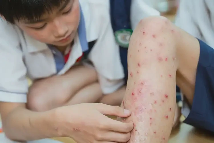 中學(xué)生小腿上偶爾起濕疹能徹底自愈嗎(圖4)