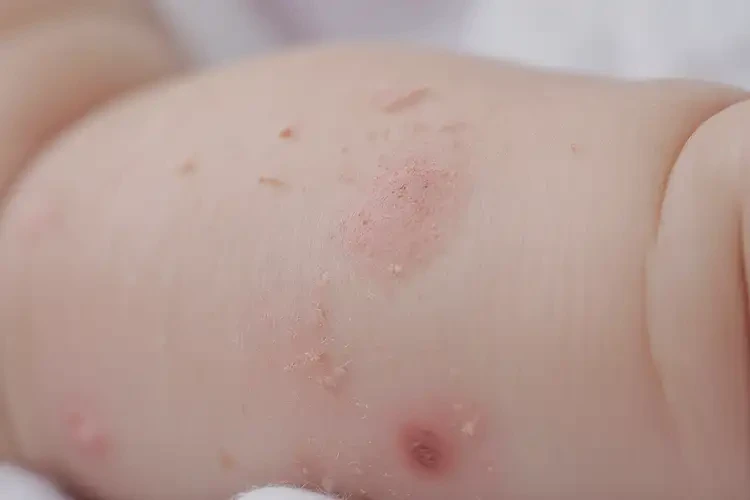 孩子屁股上容易长湿疹不管它会自己自愈吗(图4)