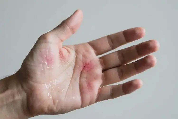 男性手上偶爾起濕疹不管它會(huì)自己好嗎(圖2)